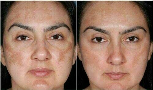 A Ret HC Cream 15g (Hydroquinone 2%/Tretinoin 0.05%/Hydrocortisone)1 tube - Image 5